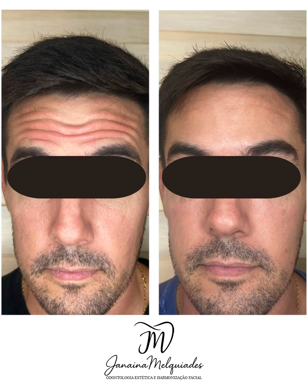 Botox — antes e depois