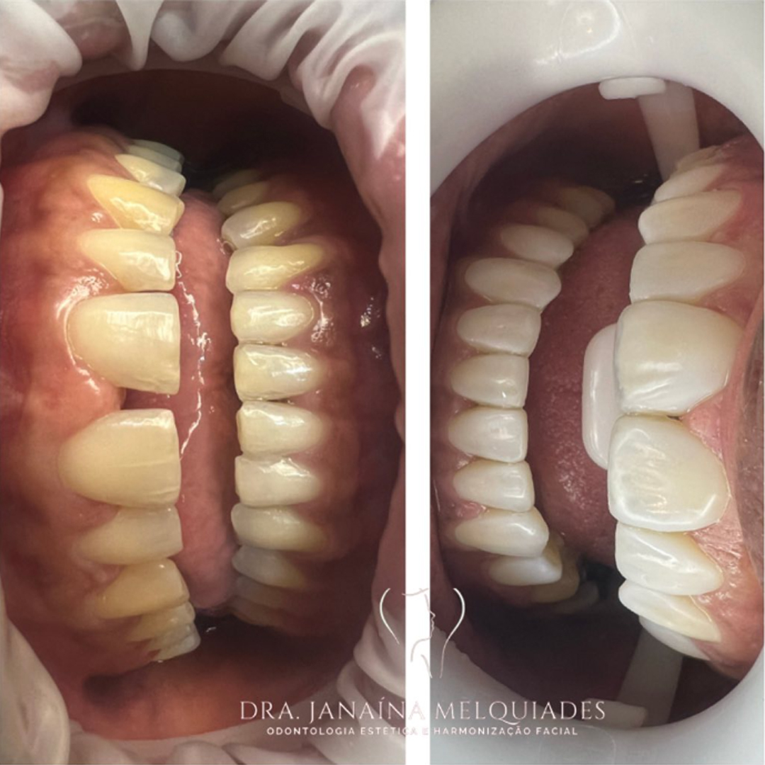 Clareamento & Facetas