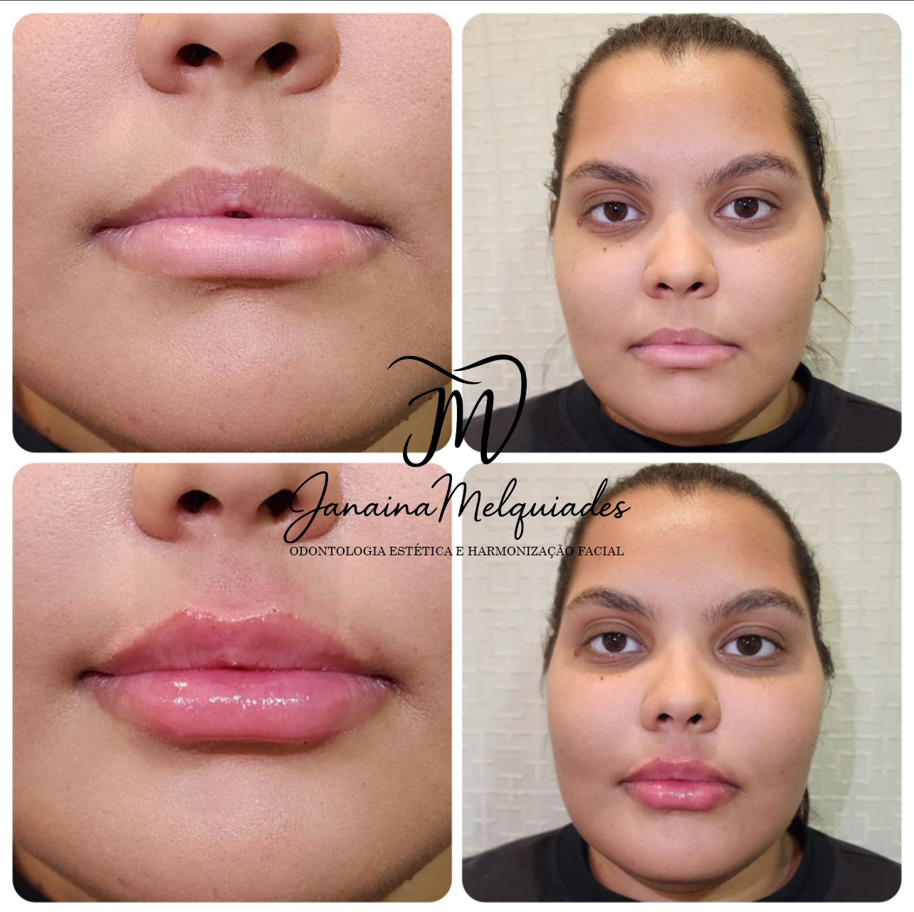 Preenchimento labial