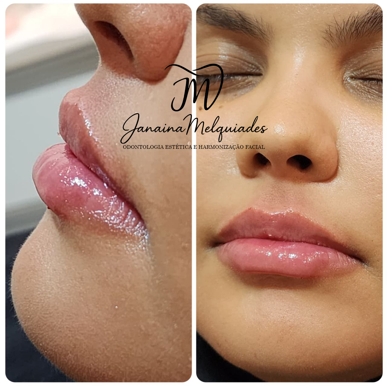 Preenchimento labial