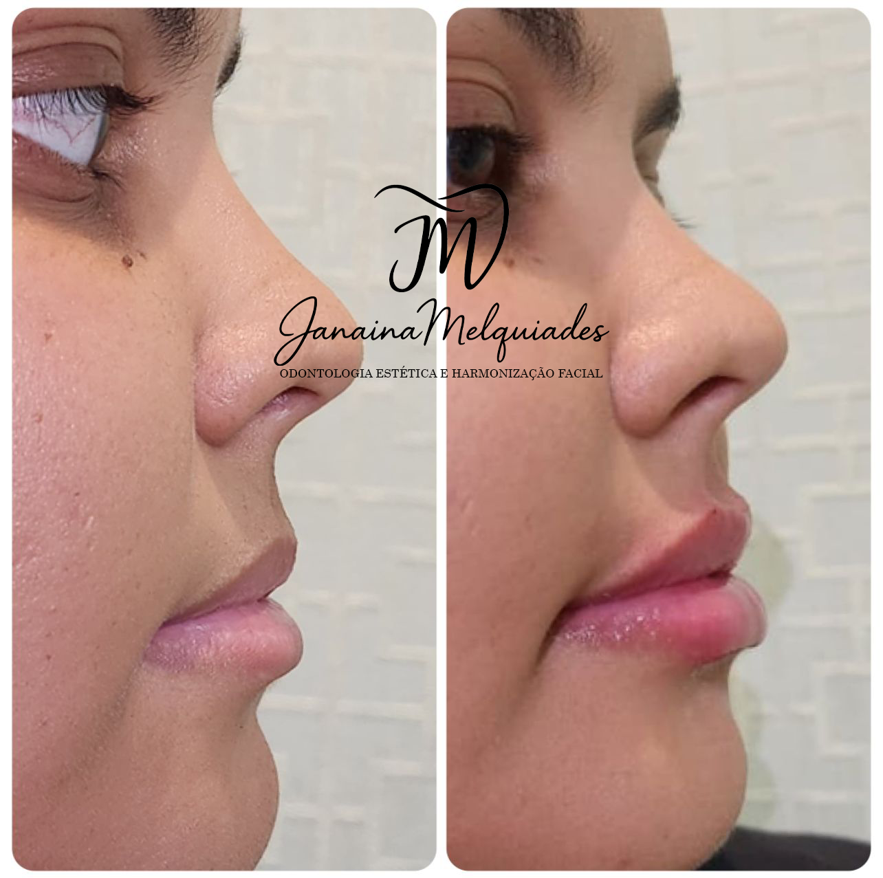 Preenchimento labial